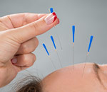 Acupuncture Needles