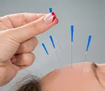Acupuncture Needles