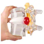 Image shows Herniated disc simulator