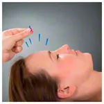 Acupuncture needles with plastic handle, 0.20x15 mm, 100 pieces