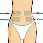 Compex electrodes wire 5x10 cm, 2 pieces