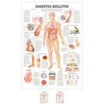 Wall chart - Diabetes Mellitus -, LxW 100x70 cm