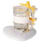 Hernia model LxWxH 19x19x19 cm