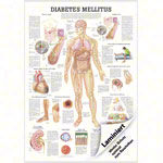 Wall chart - Diabetes Mellitus -, LxW 100x70 cm