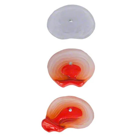 Hernia model LxWxH 19x19x19 cm