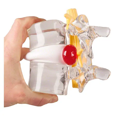Herniated disc simulator