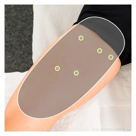 STORZ MEDICAL shock wave therapy device MASTERPULS ONE