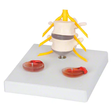 Hernia model LxWxH 19x19x19 cm