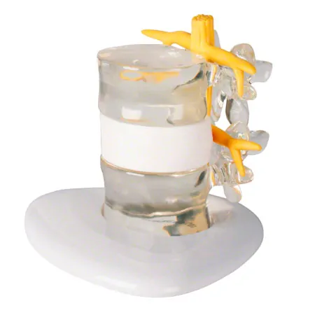 Hernia model LxWxH 19x19x19 cm