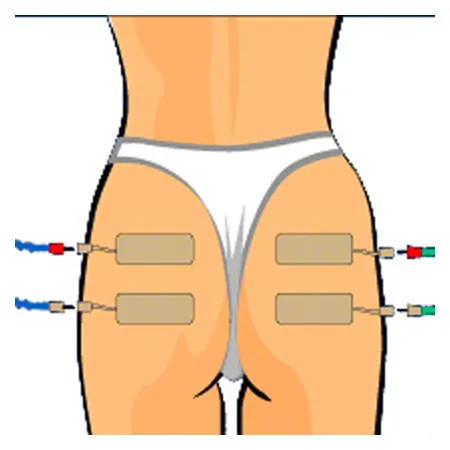 Compex electrodes wire 5x10 cm, 2 pieces