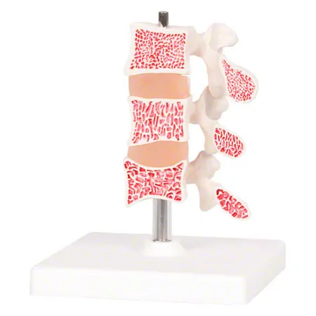 Osteoporosis model