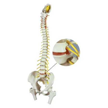Spinal column with a disc prolapse incl. stand, 80 cm
