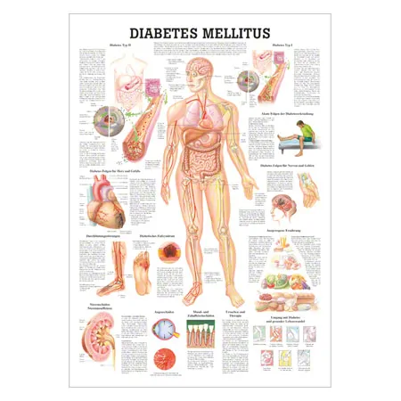 Wall chart - Diabetes Mellitus -, LxW 100x70 cm